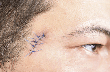 How to Know When Your Cut Needs Medical Attention